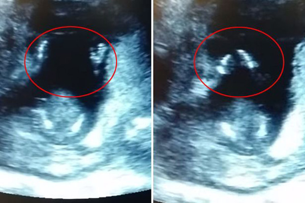 Baby Claps Hands In Ultrasound!