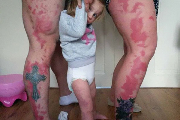 Parents Get Tattoo Of Daughter’s Birthmark So She Won’t Feel Different