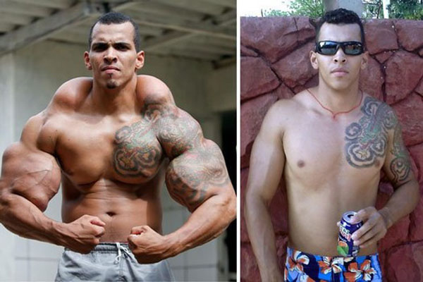 The Horrific Effects Of Muscle Injections