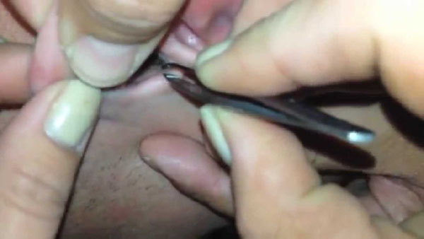 Bug Buried In Ear #VIDEO