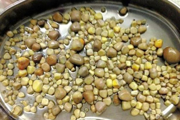 Man Has 420 Kidney Stones Removed!